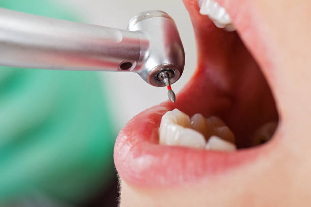 Best Emergency Root Canal Treatment in Flint, MI